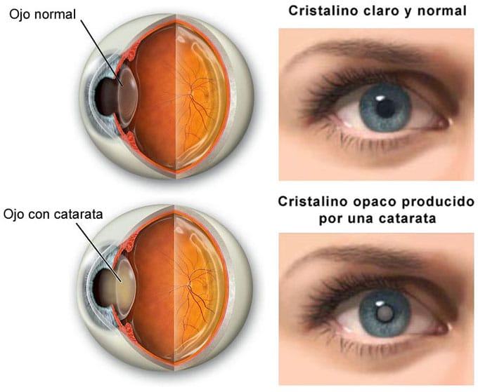 que es una catarata