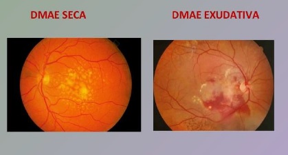 DEGENERACION MACULAR ASOCIADA A LA EDAD